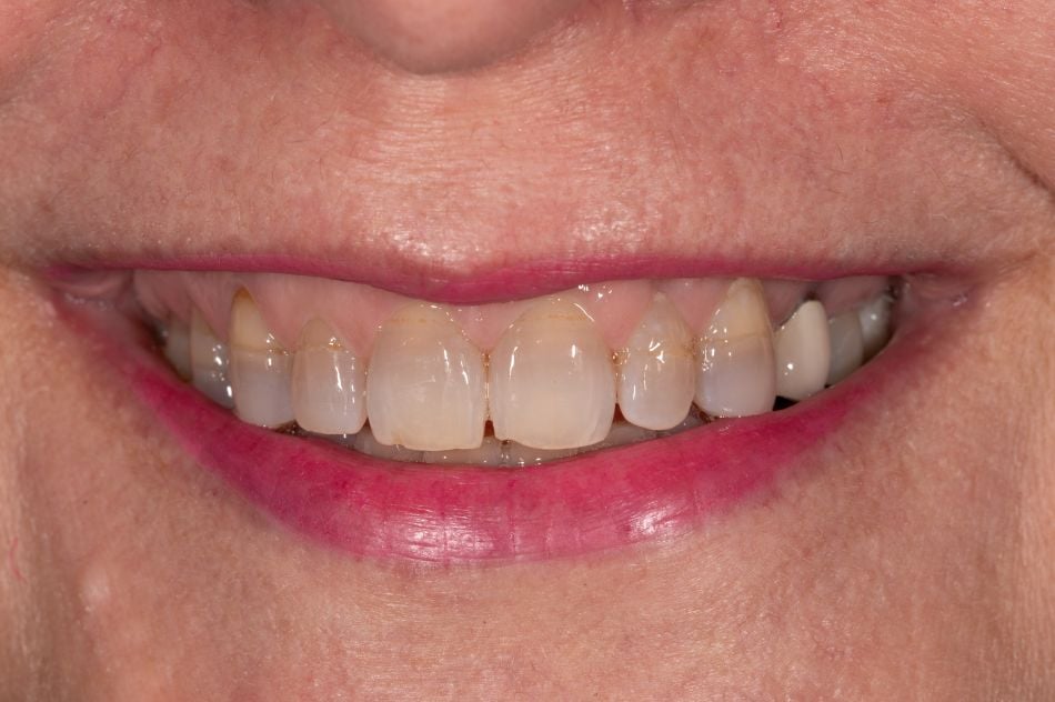Before cosmetic dental procedures