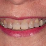 Before cosmetic dental procedures