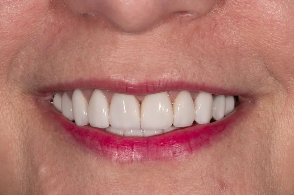 After cosmetic dental procedures