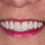 After cosmetic dental procedures