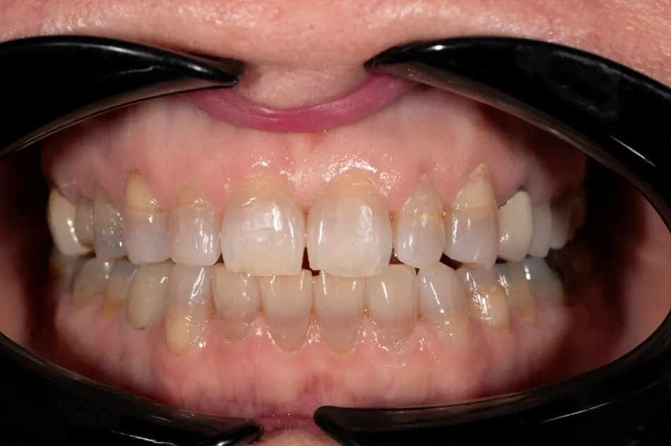 Before cosmetic dental procedures