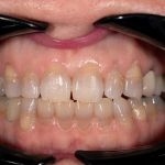 Before cosmetic dental procedures