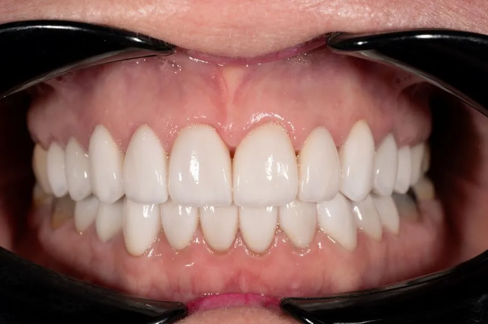 After cosmetic dental procedures