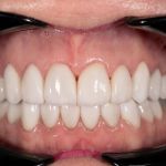 After cosmetic dental procedures
