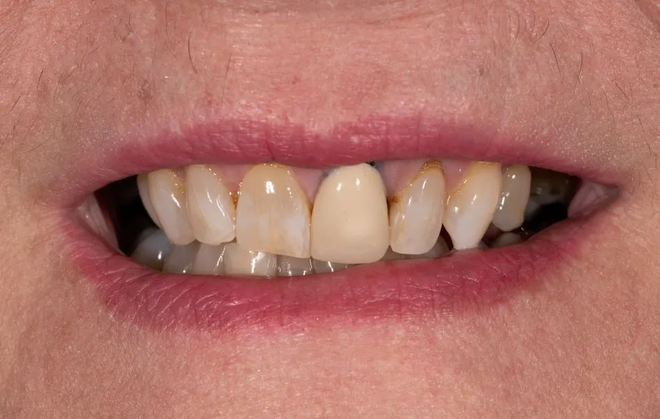 Before cosmetic dental procedures