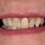 Before cosmetic dental procedures