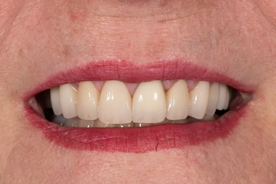 After cosmetic dental procedures