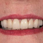After cosmetic dental procedures