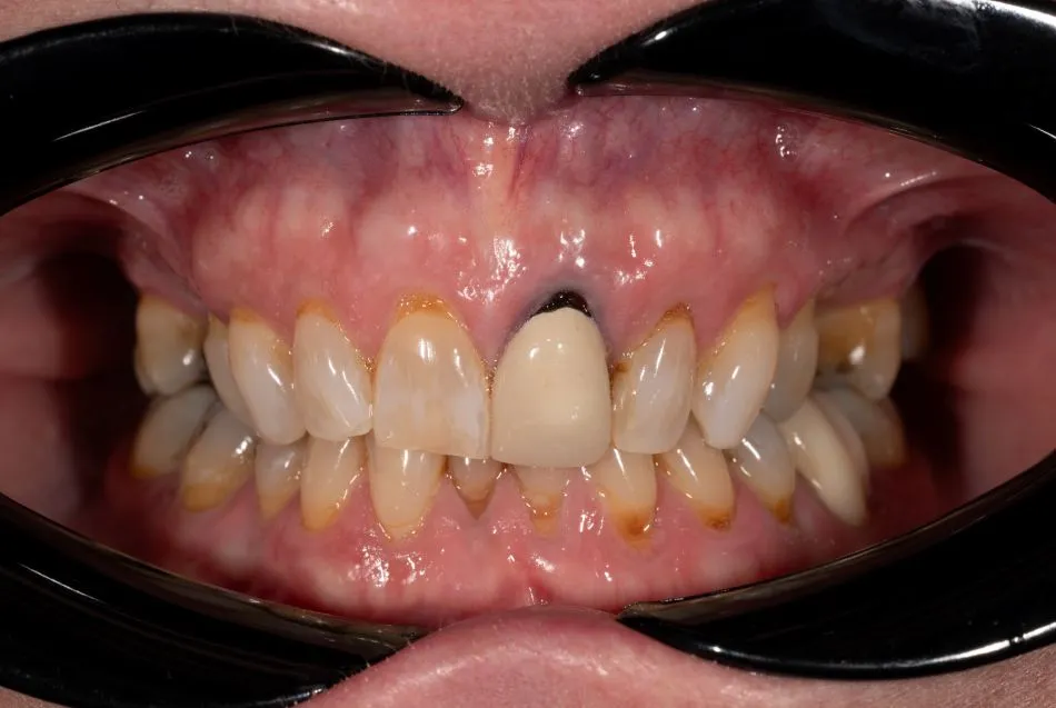 Before cosmetic dental procedures