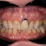 Before cosmetic dental procedures