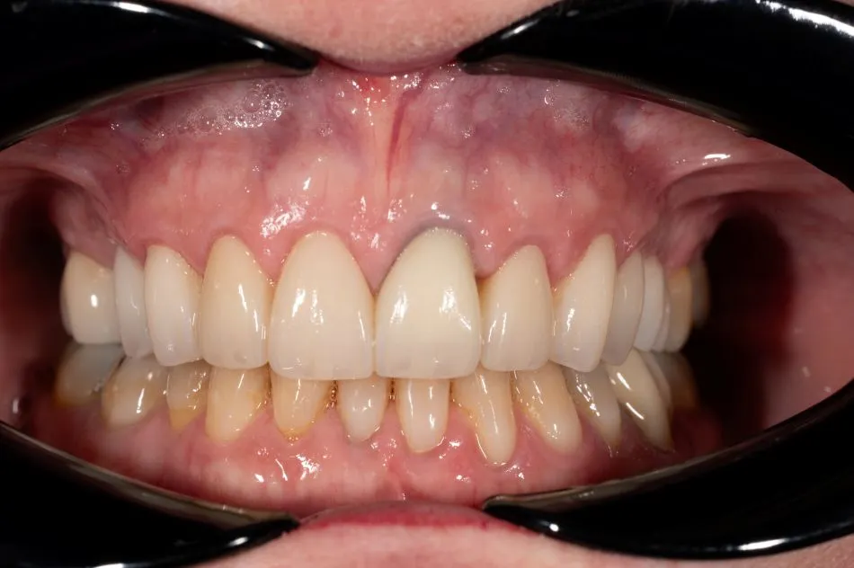After cosmetic dental procedures