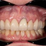 After cosmetic dental procedures