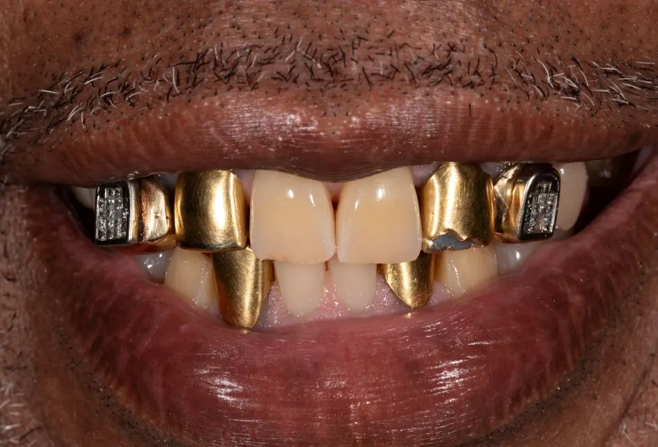 Before cosmetic dental procedures