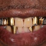 Before cosmetic dental procedures