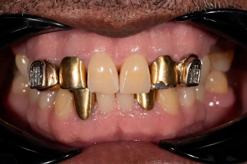 Before cosmetic dental procedures