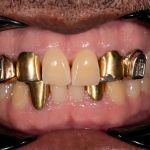 Before cosmetic dental procedures