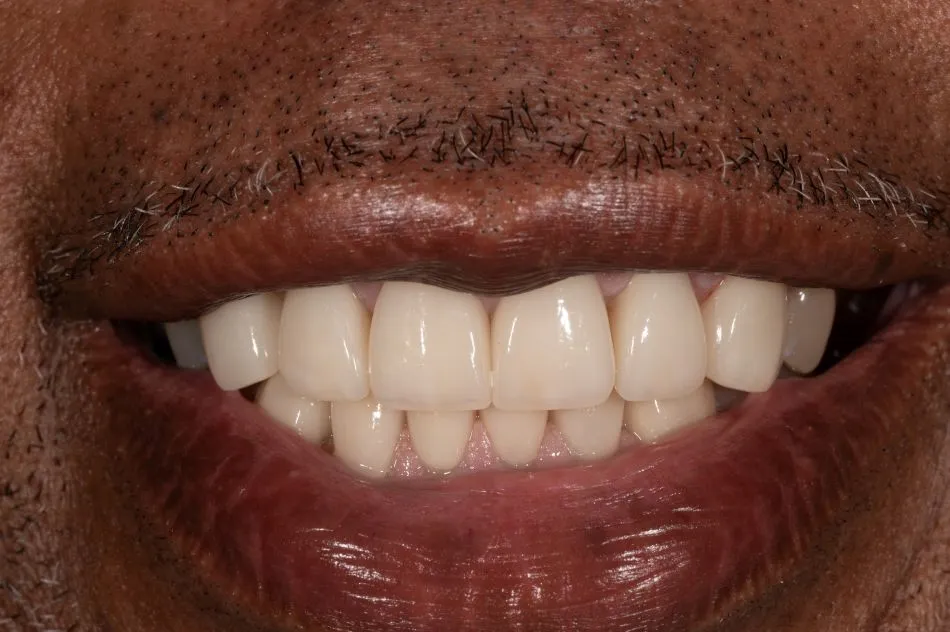 After cosmetic dental procedures