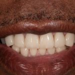 After cosmetic dental procedures