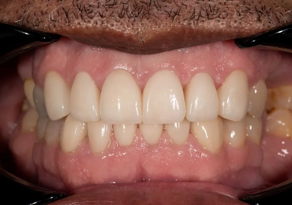 After cosmetic dental procedures