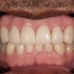 After cosmetic dental procedures