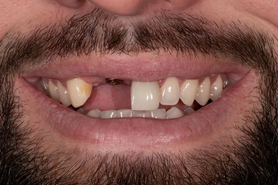 Before cosmetic dental procedures
