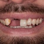 Before cosmetic dental procedures