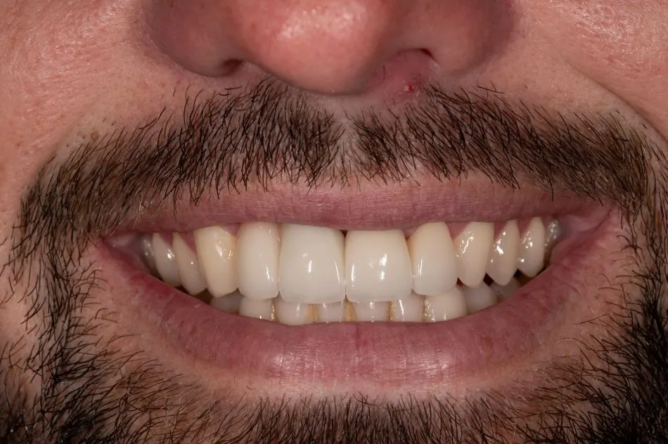 After cosmetic dental procedures