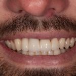 After cosmetic dental procedures