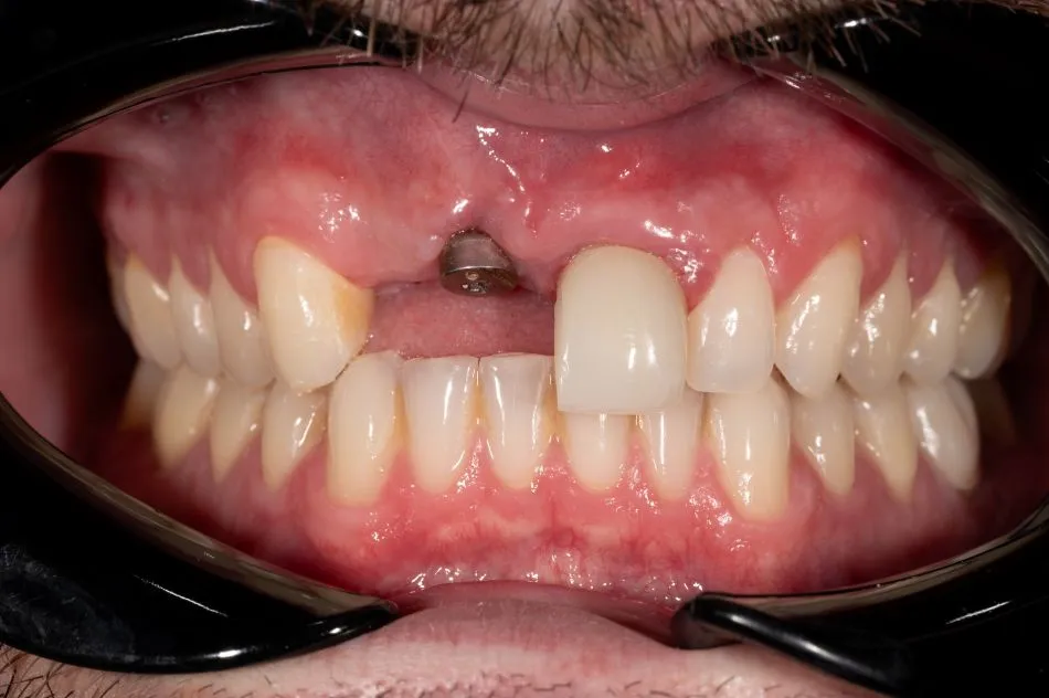 Before cosmetic dental procedures