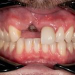 Before cosmetic dental procedures
