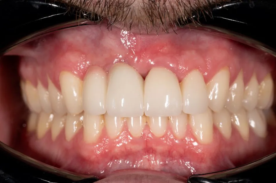 After cosmetic dental procedures