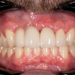 After cosmetic dental procedures
