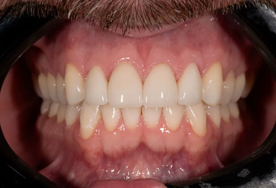 After cosmetic dental procedures