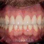 After cosmetic dental procedures