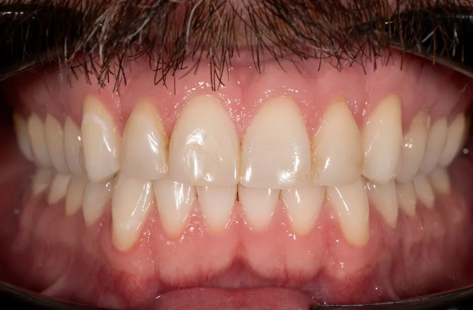 Before cosmetic dental procedures