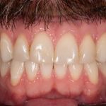 Before cosmetic dental procedures