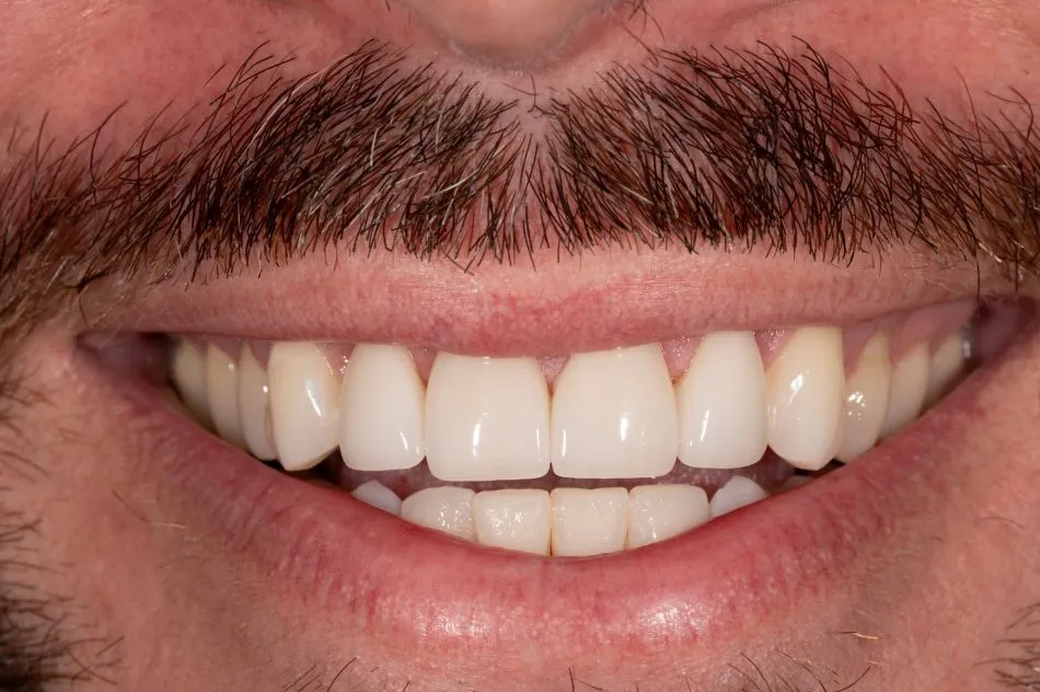 After cosmetic dental procedures