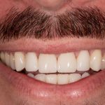 After cosmetic dental procedures