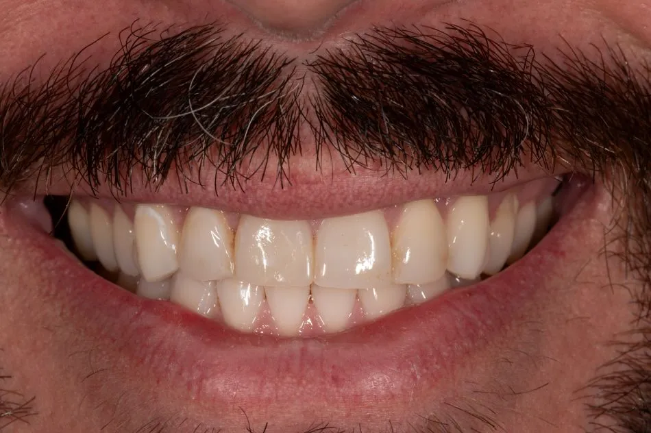 Before cosmetic dental procedures