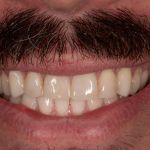 Before cosmetic dental procedures