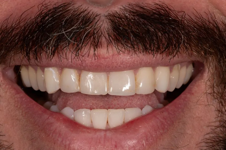 Before cosmetic dental procedures