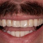 Before cosmetic dental procedures